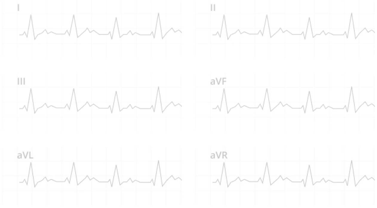 Teltohart 6-lead ECG derivations